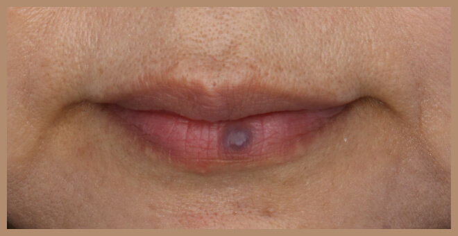 エクセルVクールビュー施術前①