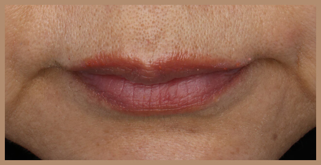 エクセルVクールビュー施術後①