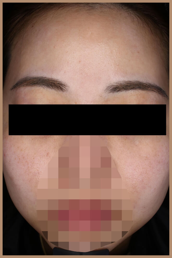 スキンニードリング 施術前正面