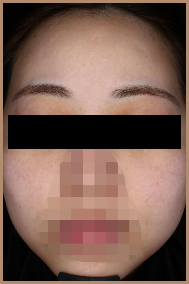 キンニードリング 施術後正面