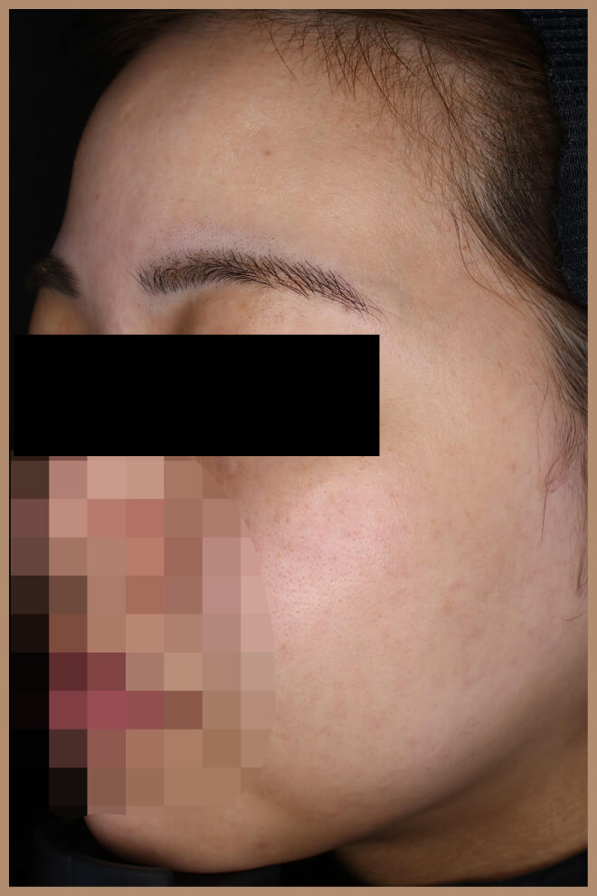 スキンニードリング 施術前左側面