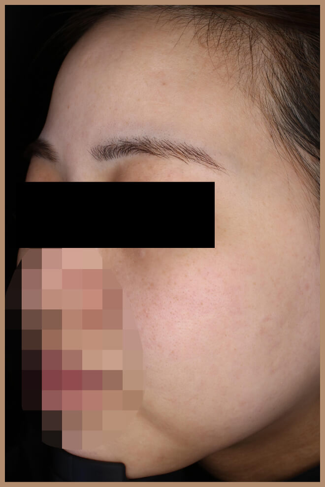 キンニードリング 施術後左側面