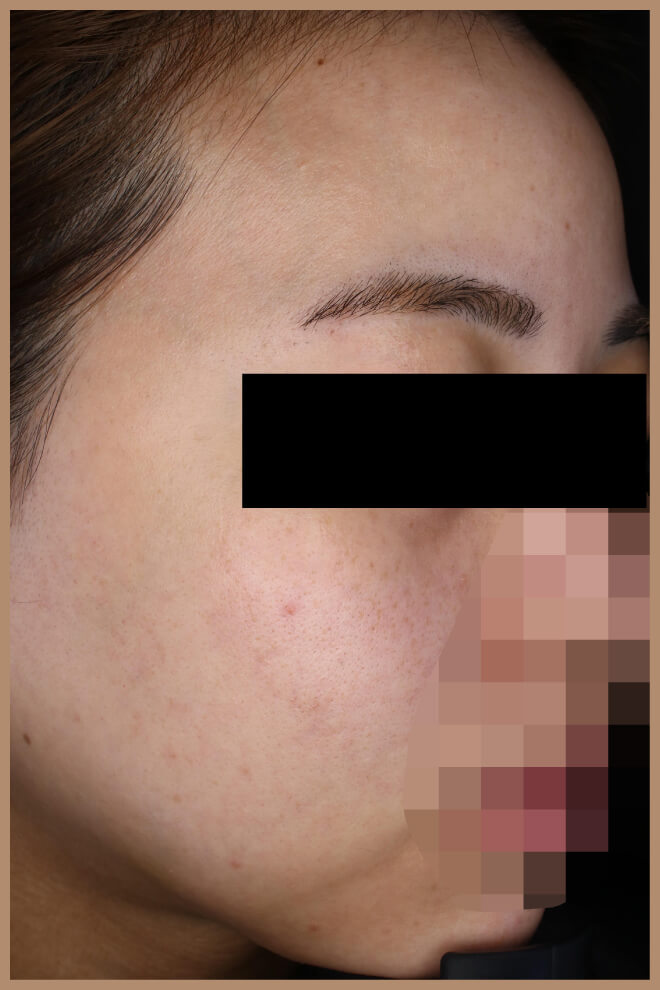 スキンニードリング 施術前右側面