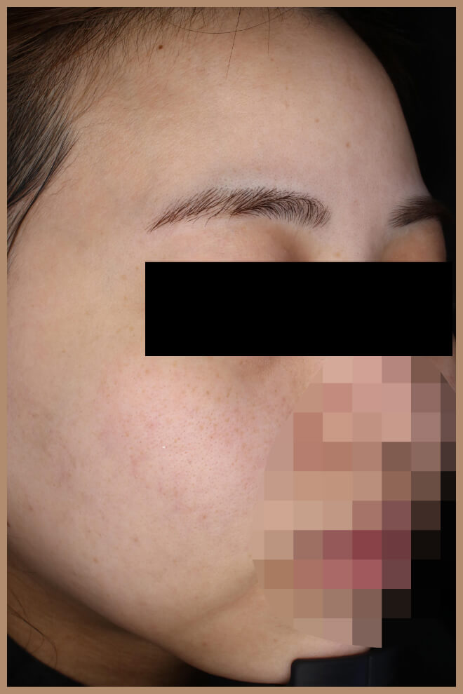 キンニードリング 施術後右側正面