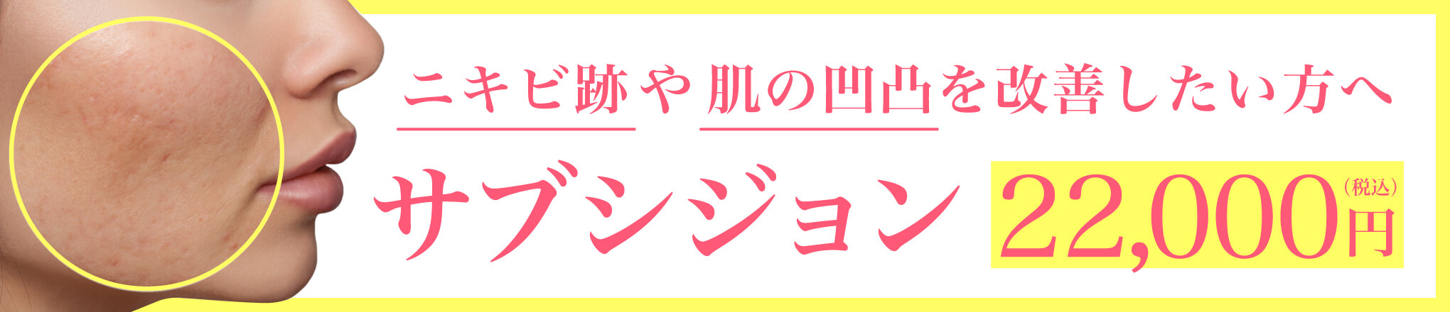 サブシジョン