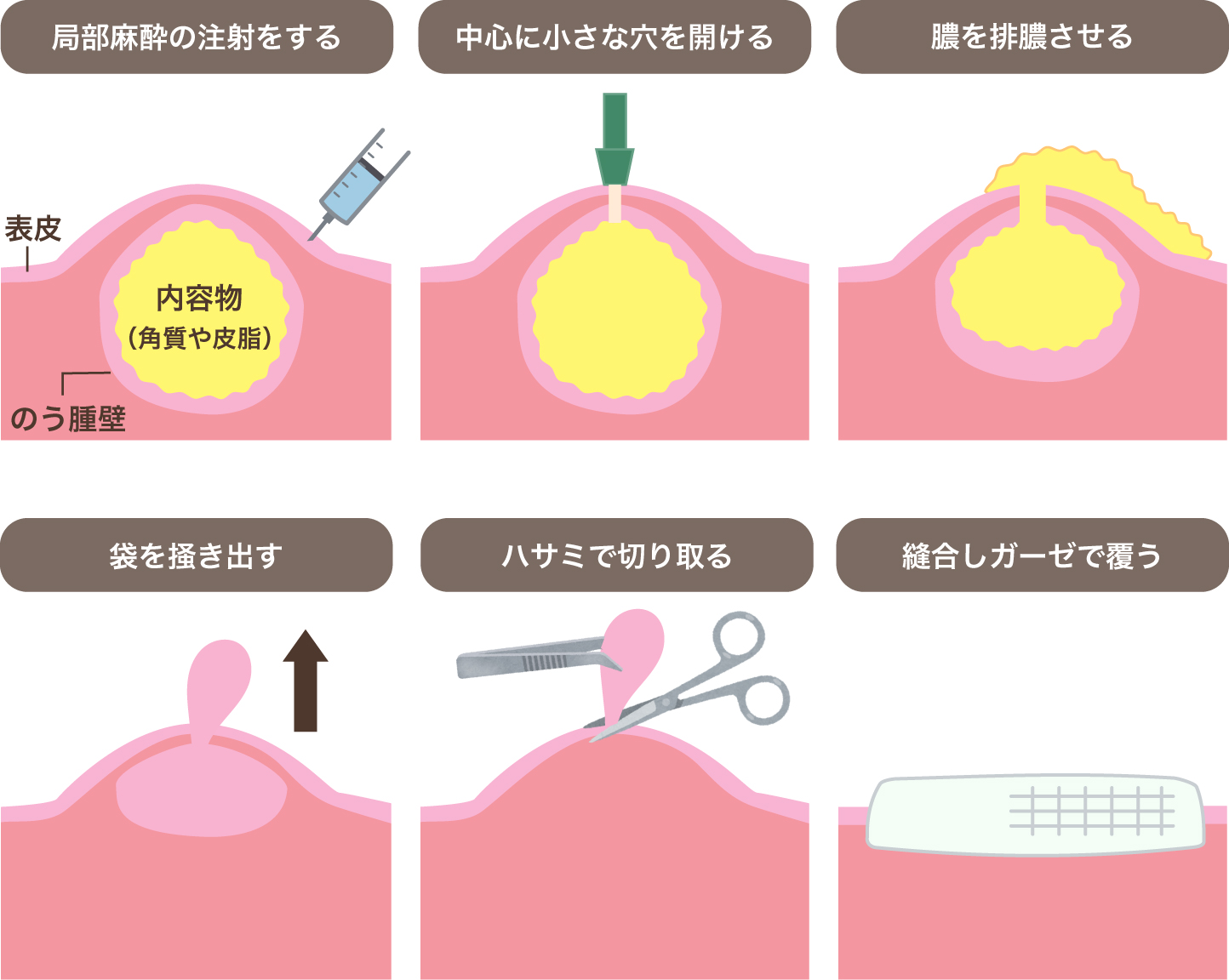 他の種類の創傷ドレナージ