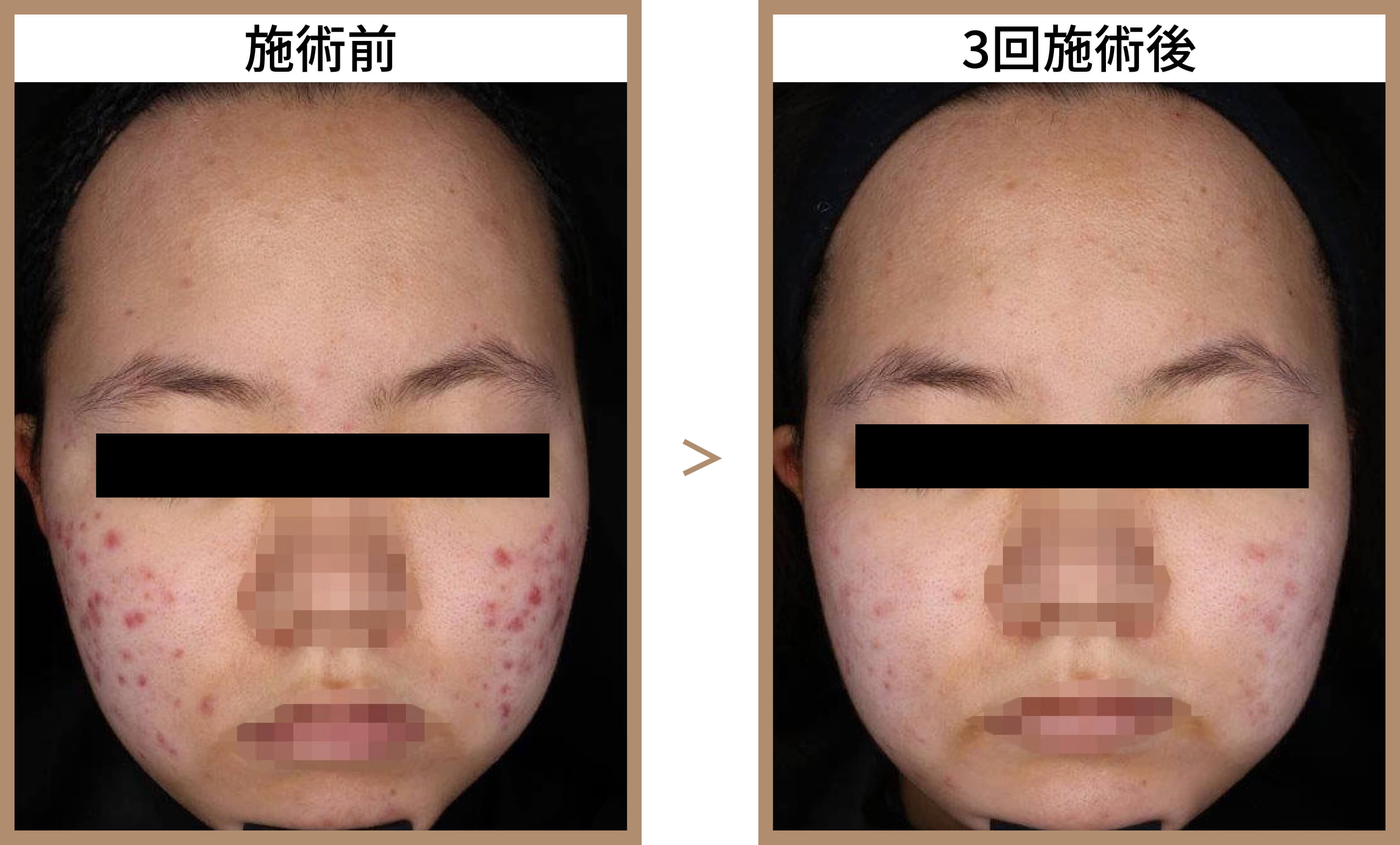 ニキビを治療するための一般的なヒント