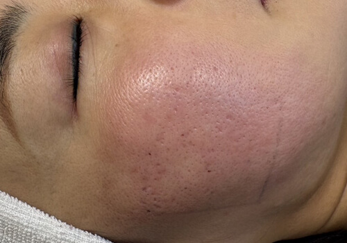 サブシジョン施術後のイメージ